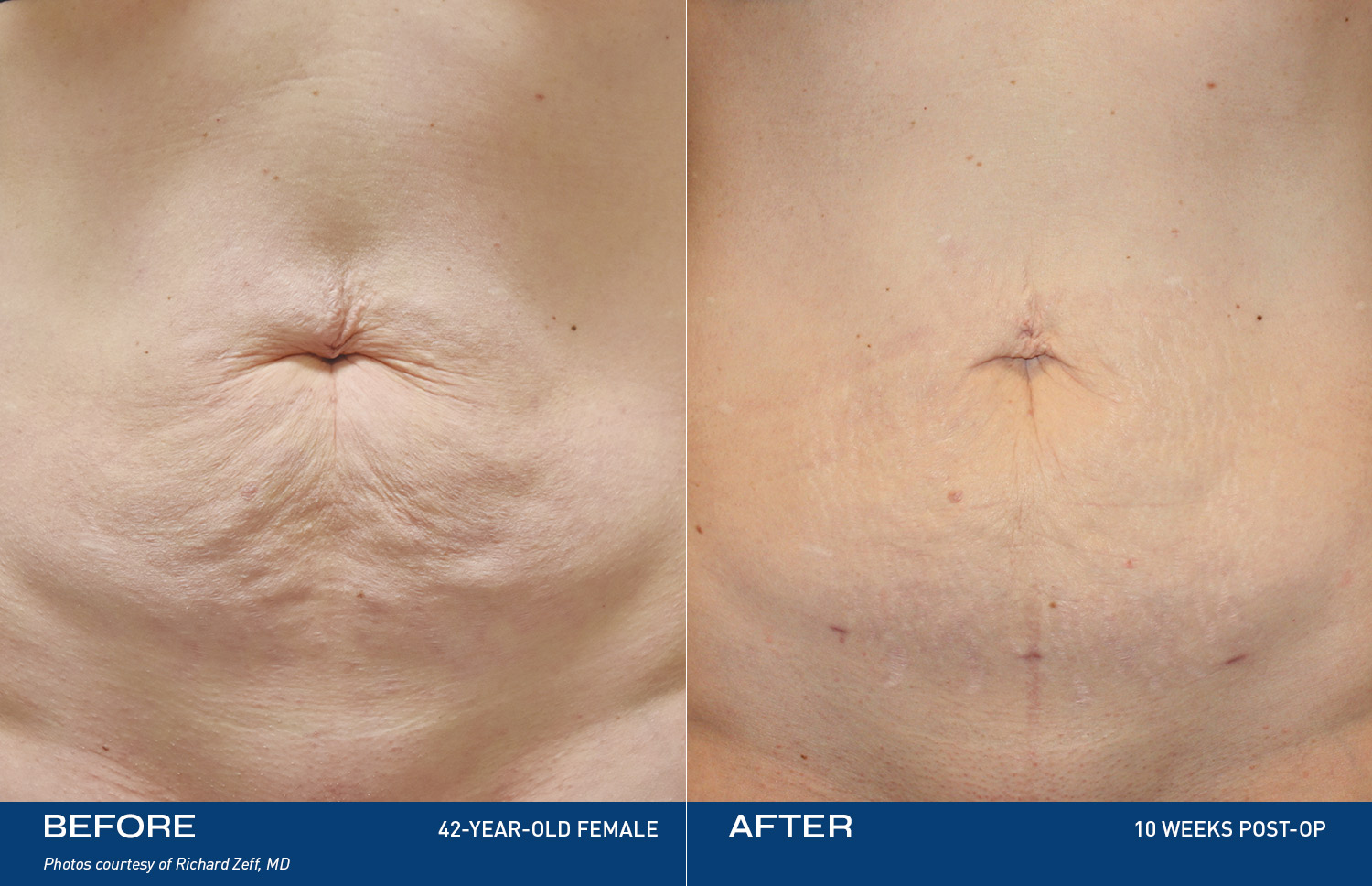 Seroma After A Tummy Tuck: How to Treat It - Leif Rogers MD